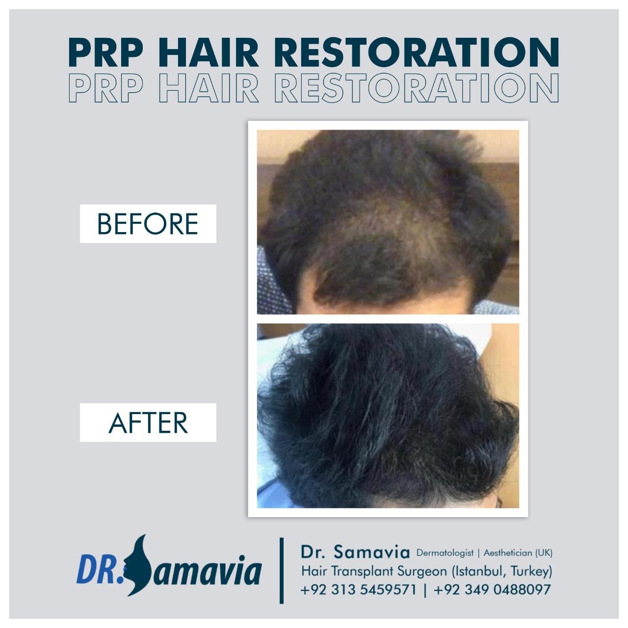 Before and After hair transplant treatment and PRP therapy patient 11