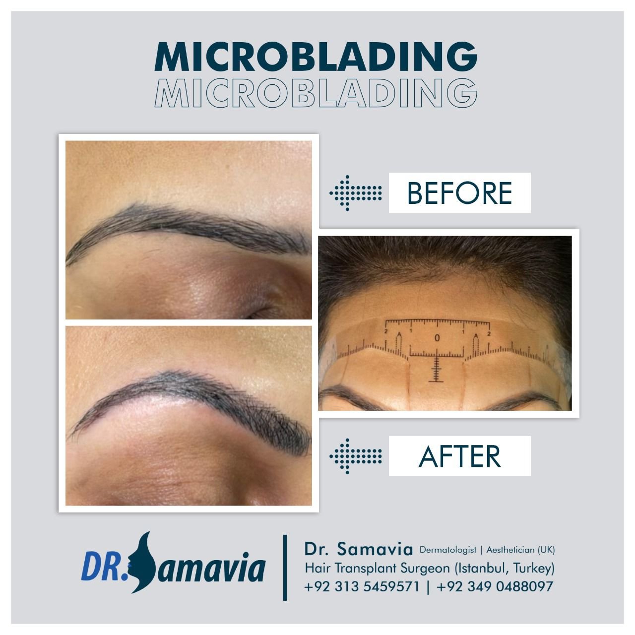 Before and After hair transplant treatment and PRP therapy patient 2