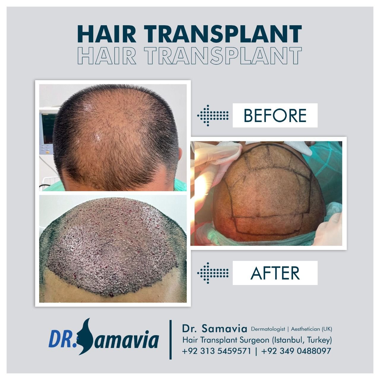 Before and After hair transplant treatment and PRP therapy patient 3