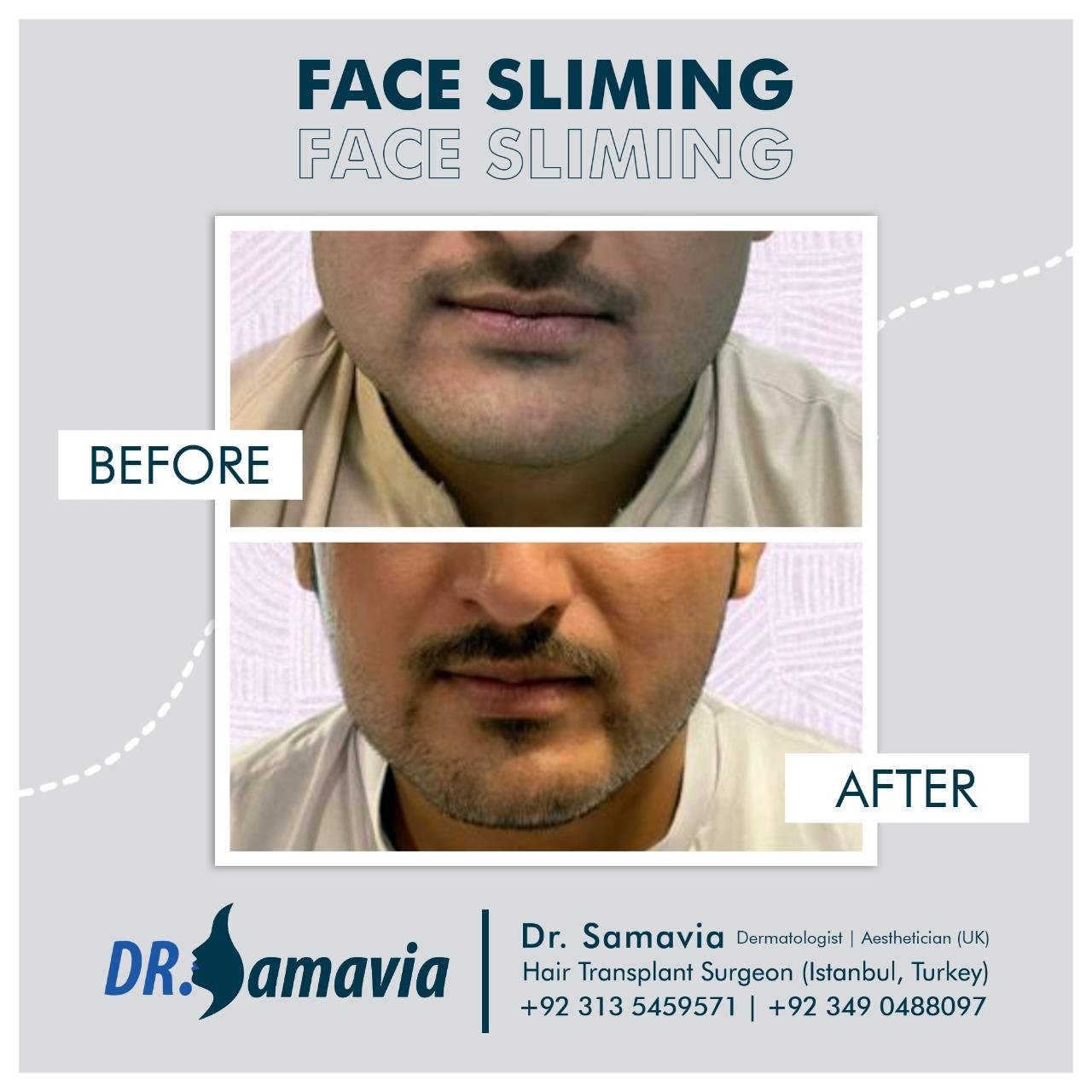 Before and After hair transplant treatment and PRP therapy patient 4