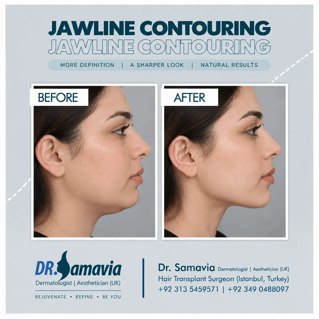 Jawline Contouring