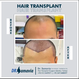 Hair transplant before and after result