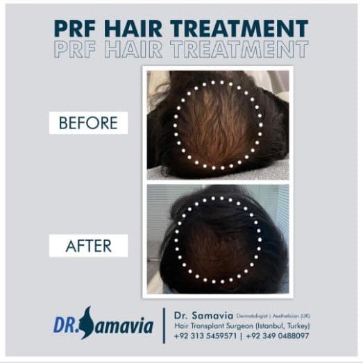 PRF Hair Treatment consultation at Dr Samavia Clinic Islamabad