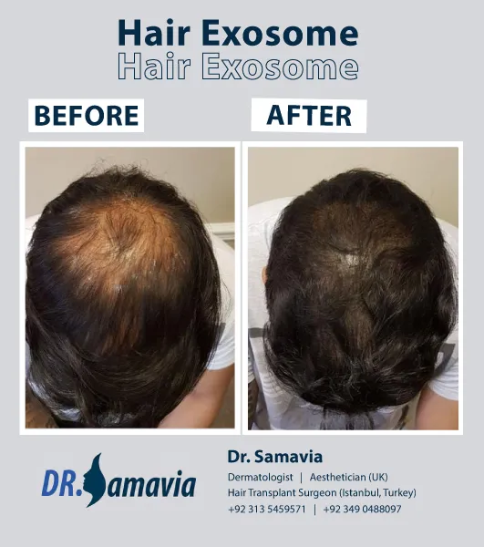 Hair Exosome Treatment consultation at Dr Samavia Clinic Islamabad