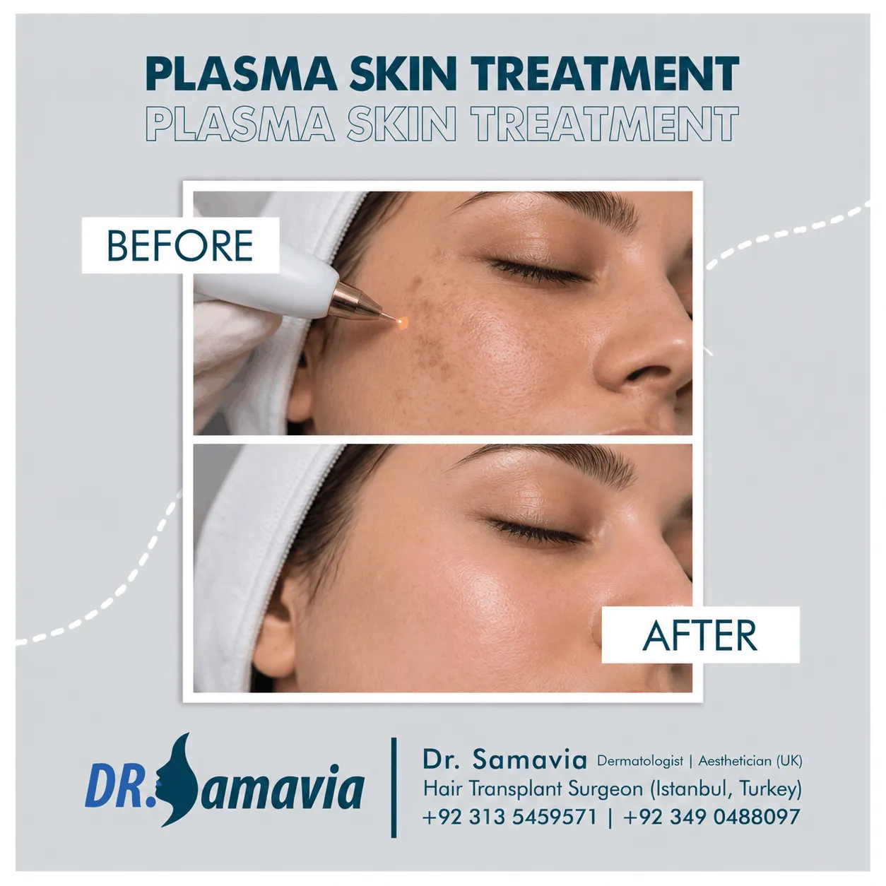 Plasma Skin Treatment consultation at Dr Samavia Clinic Islamabad