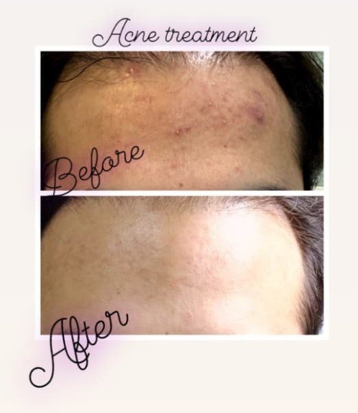 Acne Treatment
