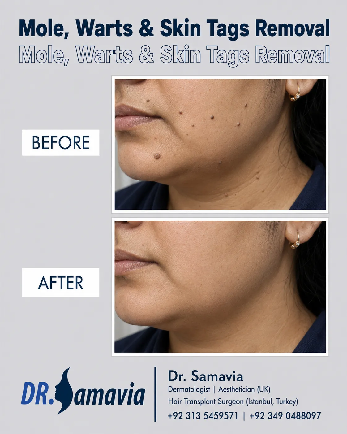 Mole, Warts & Skin Tags Removal consultation at Dr Samavia Clinic Islamabad