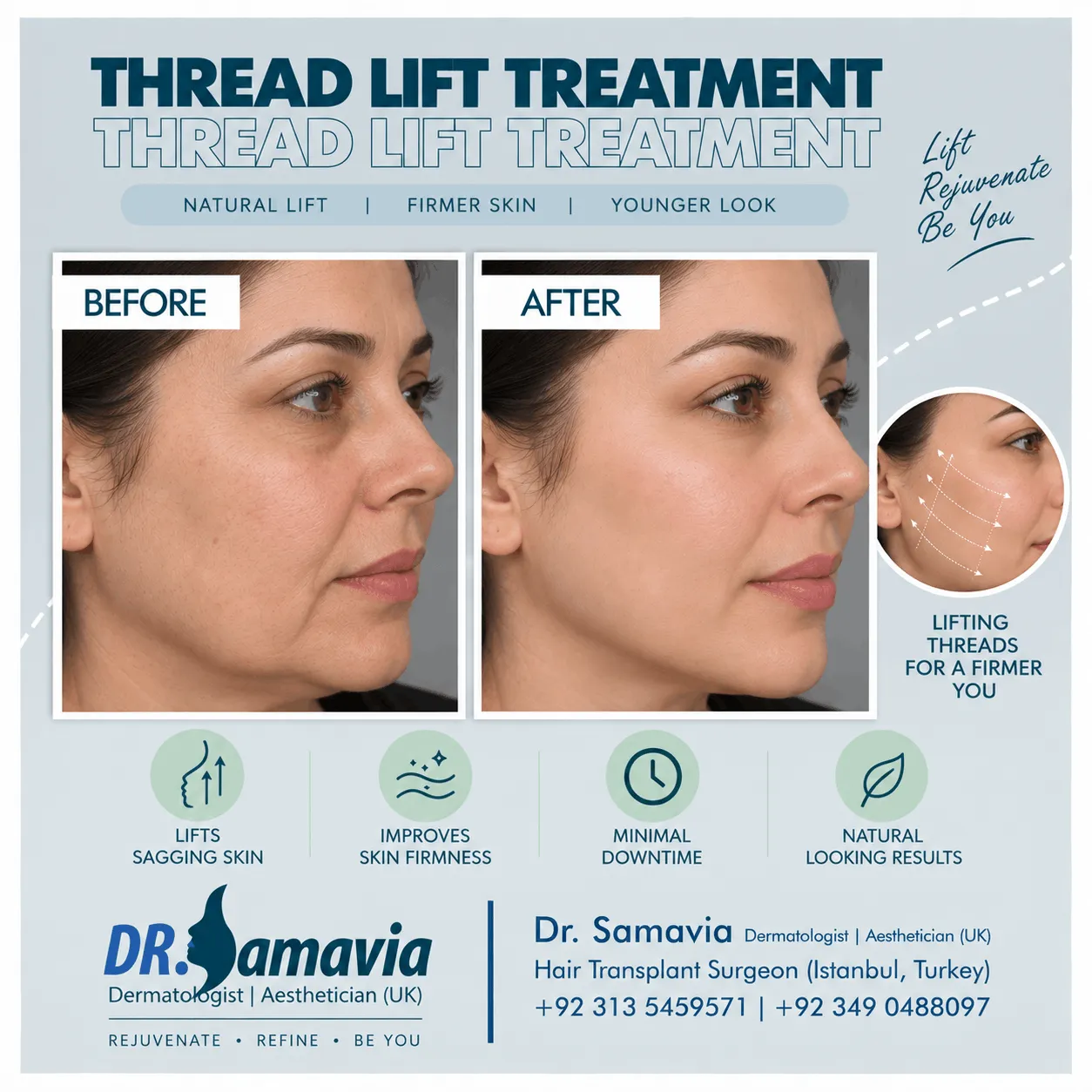Thread Lift Treatment consultation at Dr Samavia Clinic Islamabad