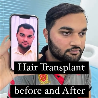 Hair restoration before and after result