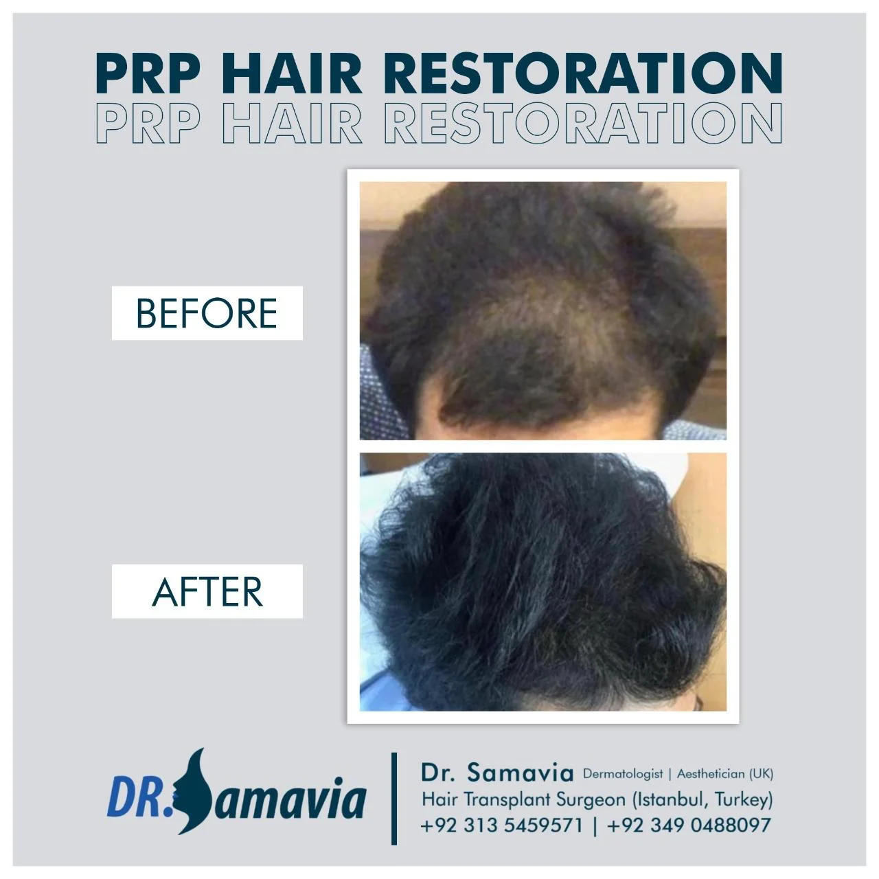 Hair transplant before and after result