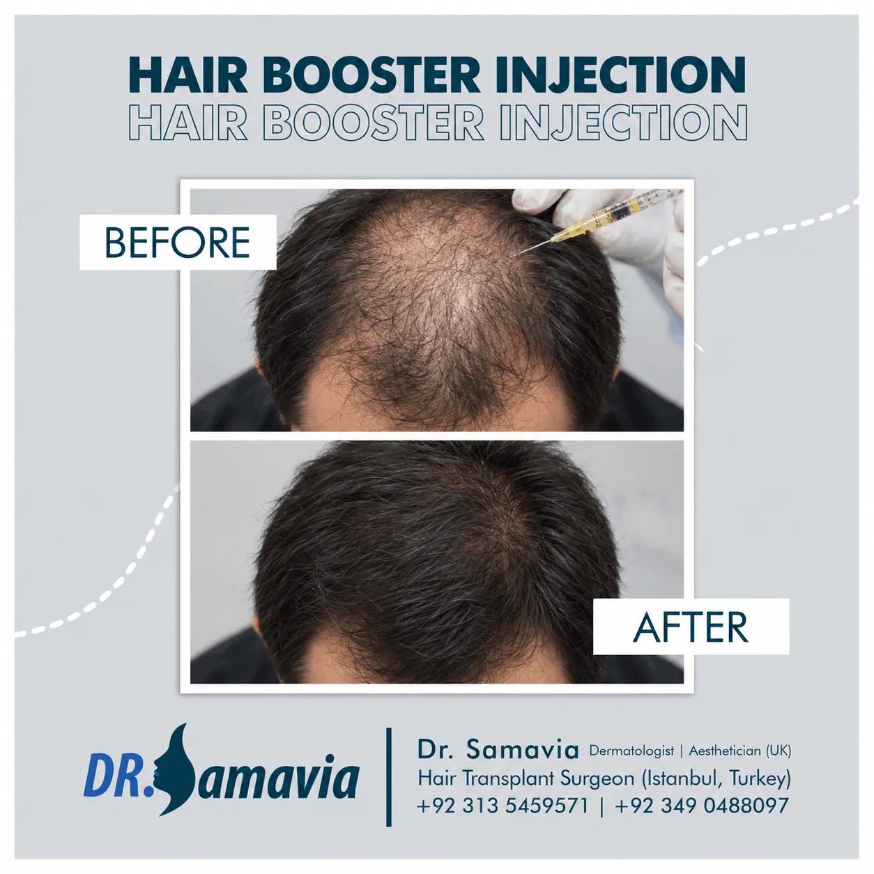 Hair Booster Injection consultation at Dr Samavia Clinic Islamabad