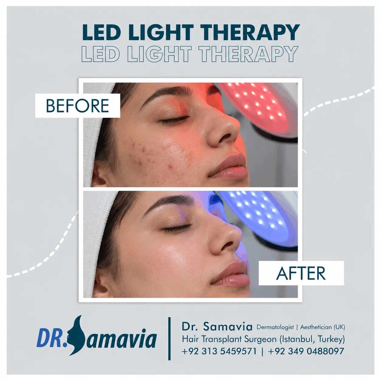 LED Light Therapy consultation at Dr Samavia Clinic Islamabad