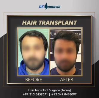 Hair transplant before and after result