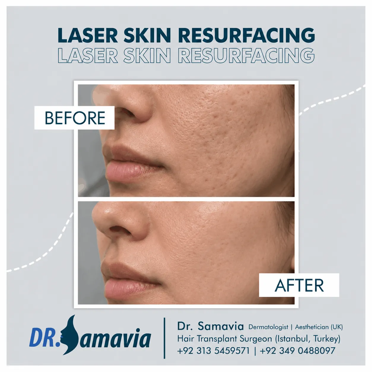 Laser Skin Resurfacing consultation at Dr Samavia Clinic Islamabad