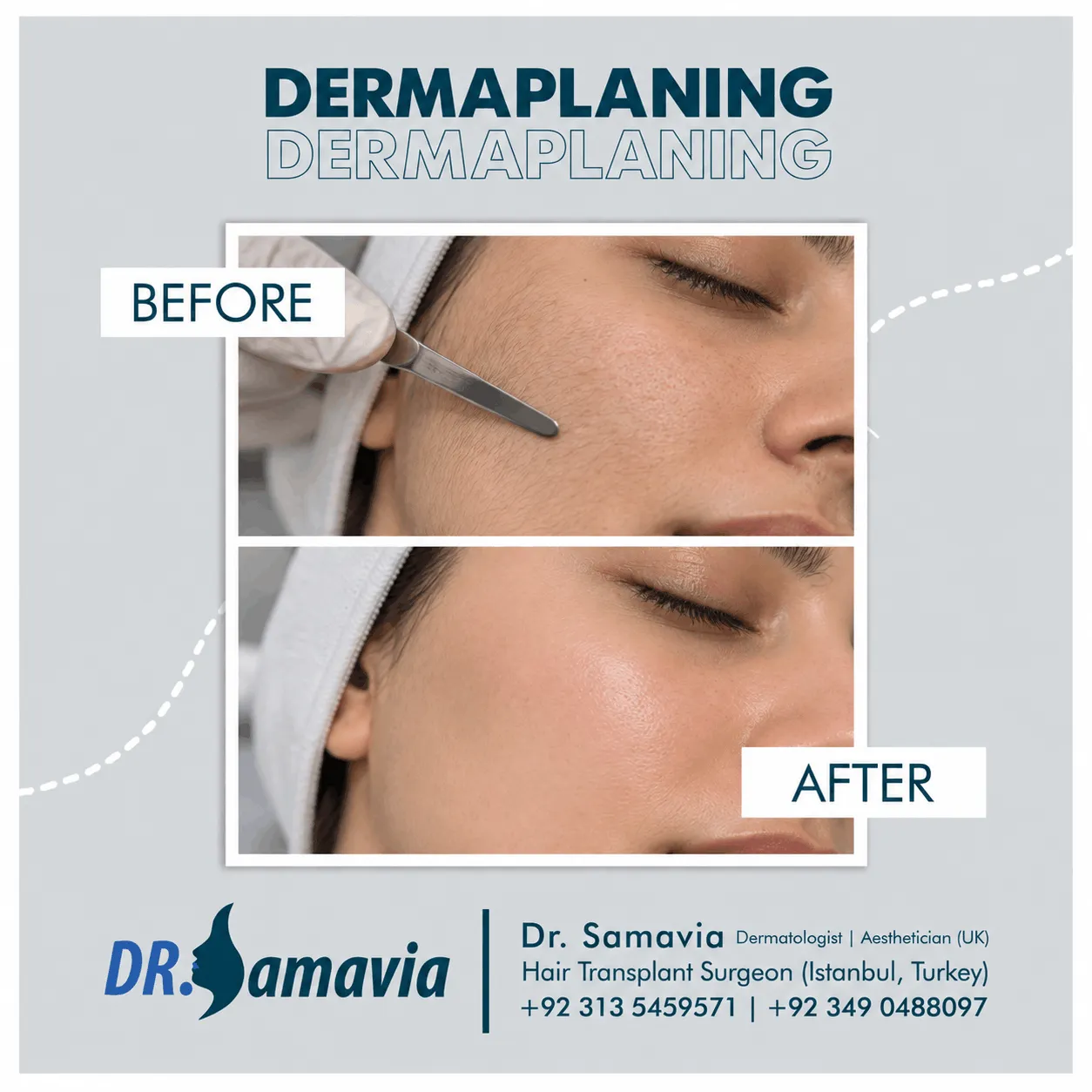 Dermaplaning consultation at Dr Samavia Clinic Islamabad