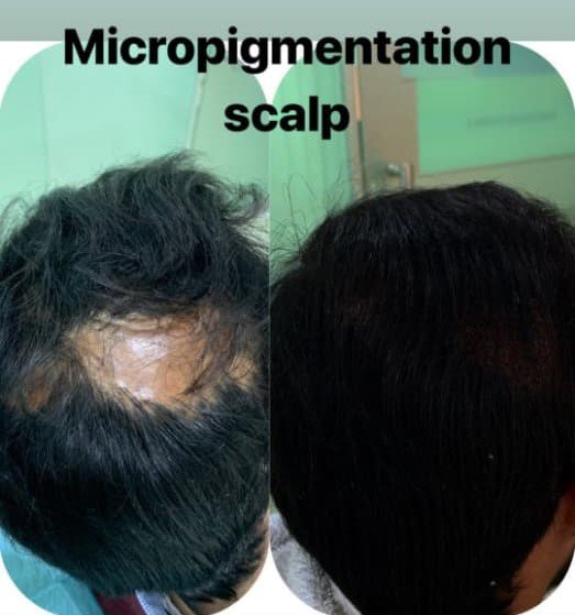Scalp Micropigmentation consultation at Dr Samavia Clinic Islamabad